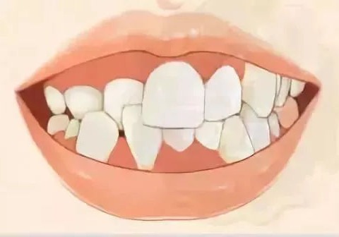 龅牙一直不矫正的话会有什么危害？