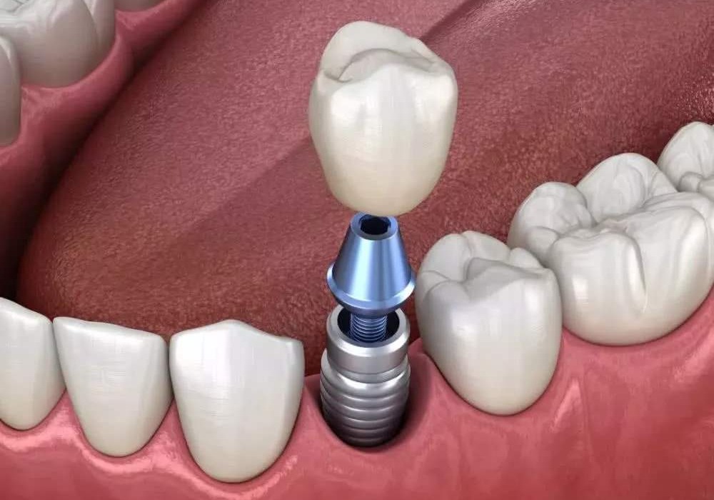 种植牙的流程是什么样的？