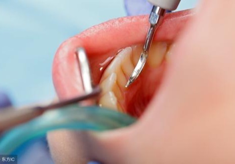 树脂补牙一般能用多久?价格是多少钱?