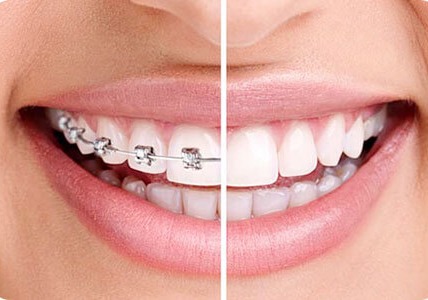 牙齿稀疏要怎么矫正？